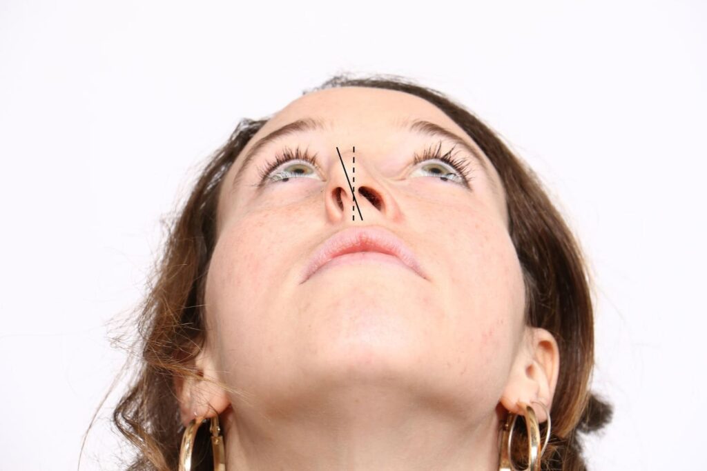 Close-up underside view of a woman’s nose showing the nostrils, used to illustrate nostril symmetry after rhinoplasty.