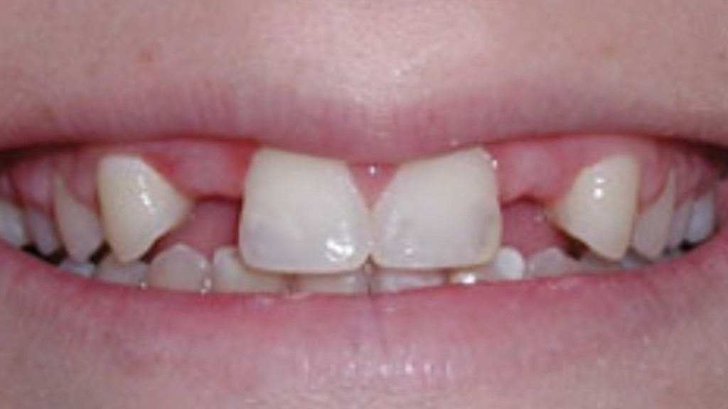 IMG 9065 Before & After