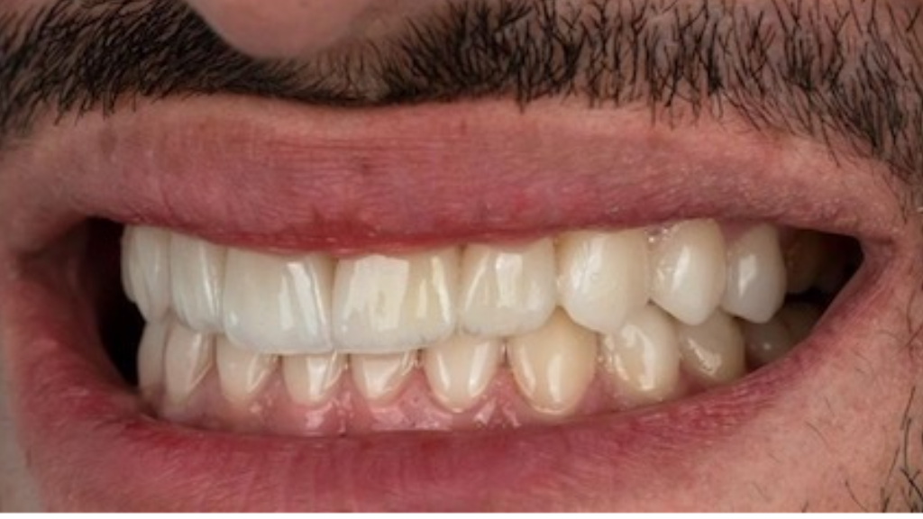 IMG 9074 Before & After