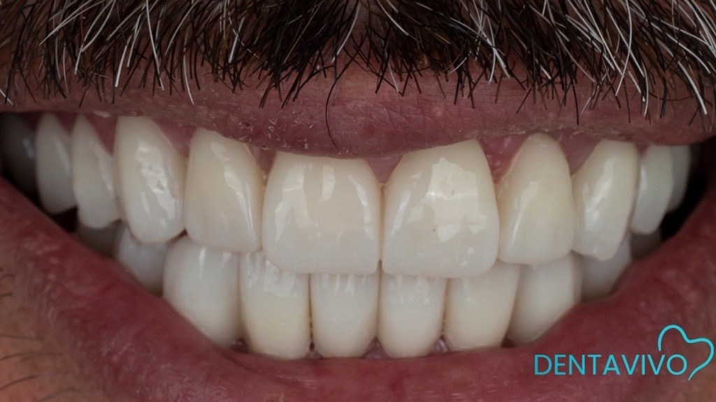 IMG 9101 Before & After