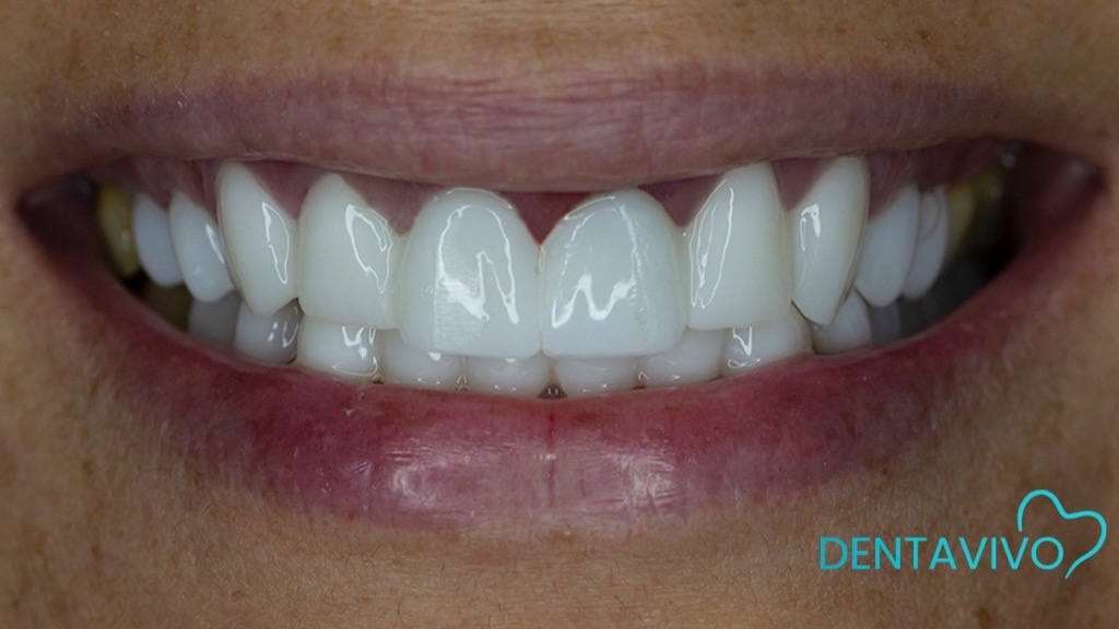 IMG 9102 Before & After