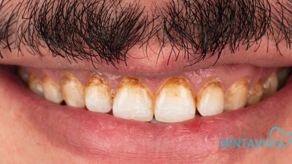 IMG 9105 Before & After