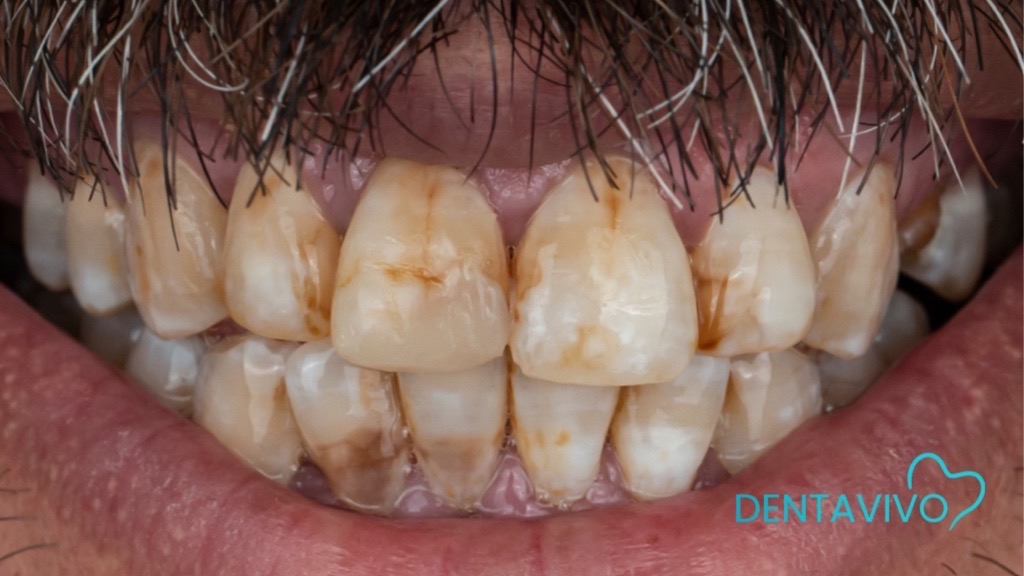 IMG 9107 Before & After