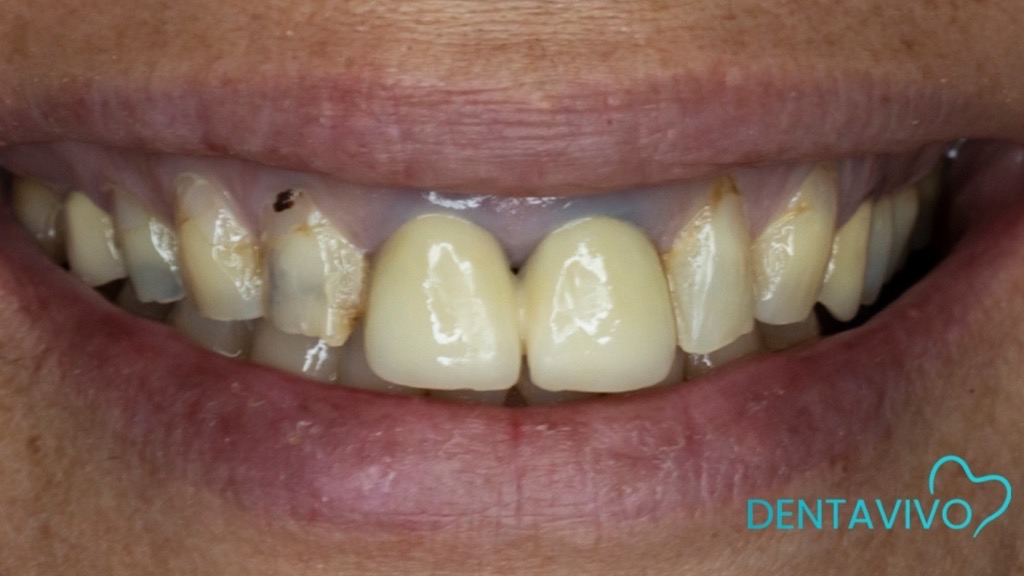 IMG 9108 Before & After