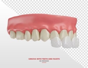 3d scan side view veneers impression