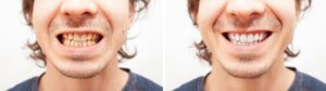 close up portrait smile teeth man before after teeth whitening alignment braces banner