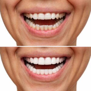 veneers before and after