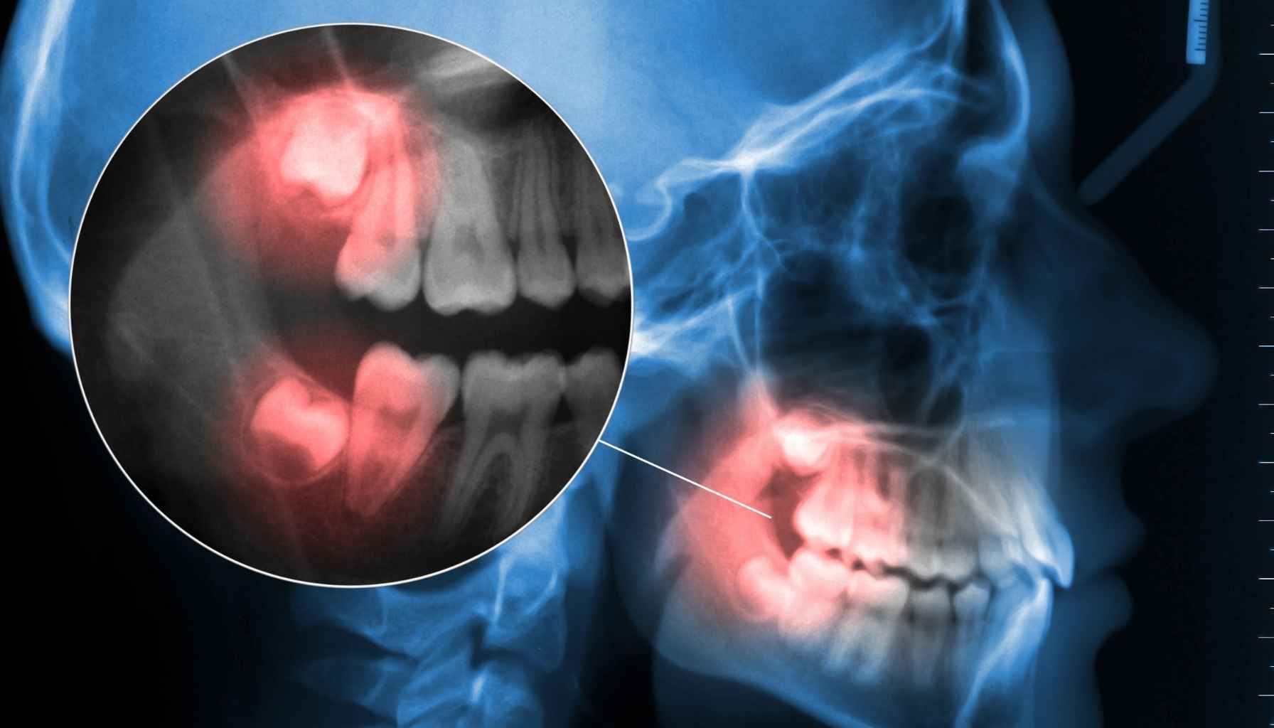 wisdom tooth
wisdom tooth x-ray