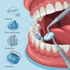 Illustration showing the steps of the dental bonding process including etching, resin application, sculpting, and polishing.