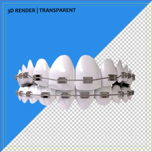 3D dental model of teeth with orthodontic braces used for educational purposes.