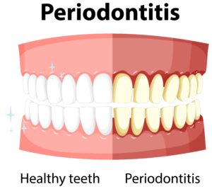 Illustration comparing healthy gums versus periodontitis with gum and bone loss Swollen Gums with Braces? Here’s How to Soothe and Heal Fast