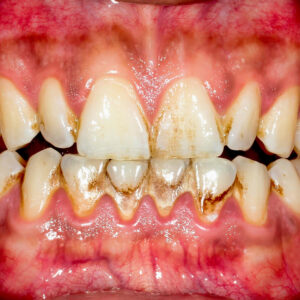 Severely swollen, inflamed gums and plaque buildup showing gum disease progression