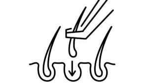 hair transplant Turkey