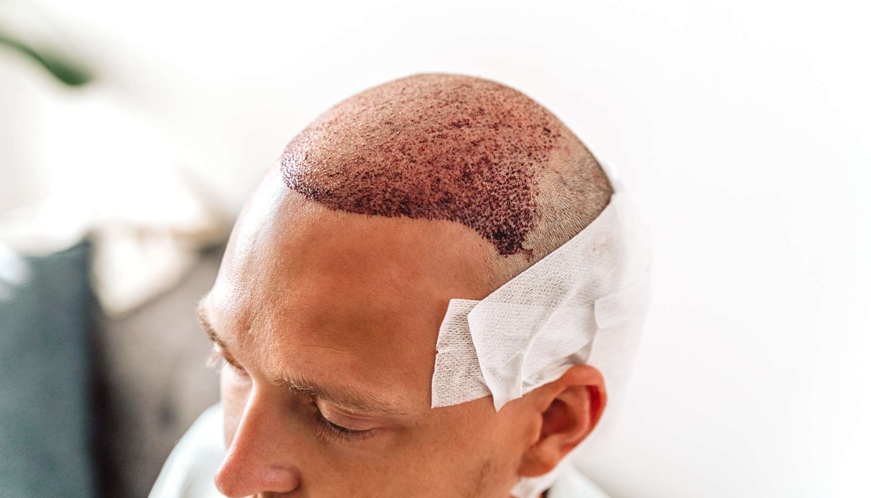 hair transplant post - hair transplant