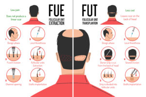 FUT vs. FUE hair transplant