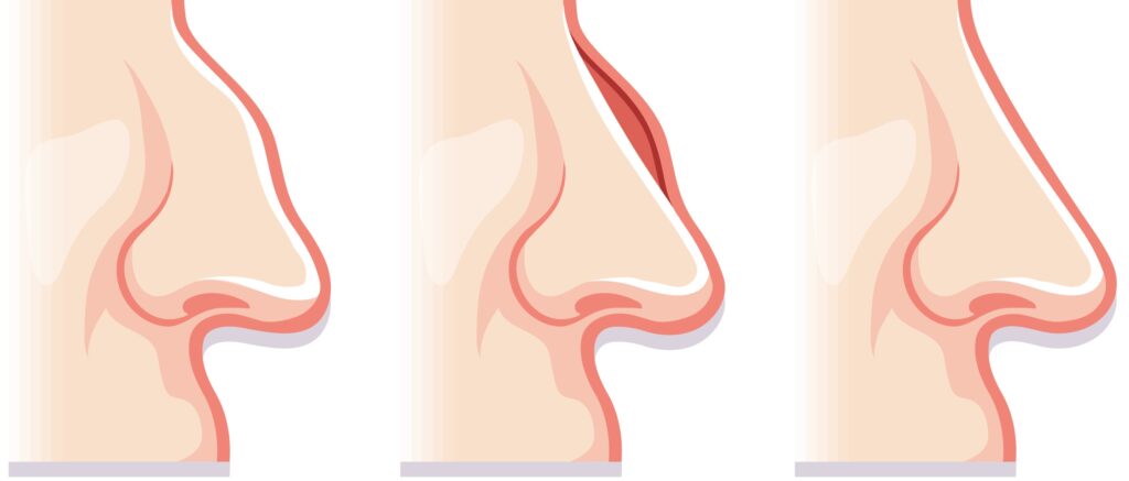 Nose Job
Rhinoplasty
