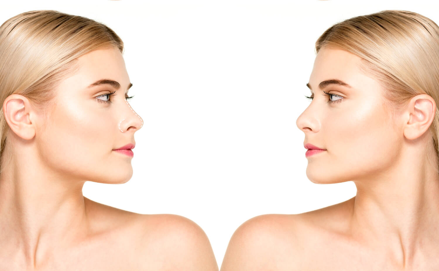 Rhinoplasty Turkey Istanbul