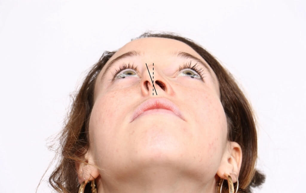 Deviated Septum, Functional Rhinoplasty